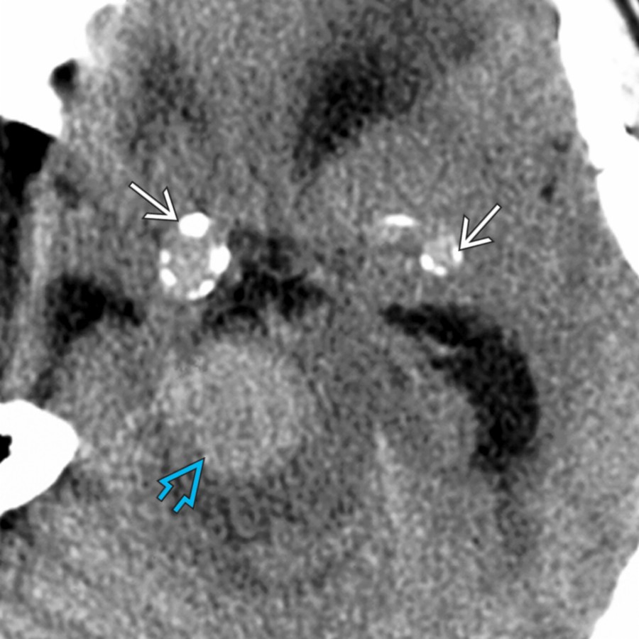 Axial NECT shows a hyperdense, fusiform basilar artery aneurysm
and calcified, fusiform aneurysmal ectasias of both ICAs
. Fusiform aneurysms are often related to atherosclerotic disease, as in this patient.