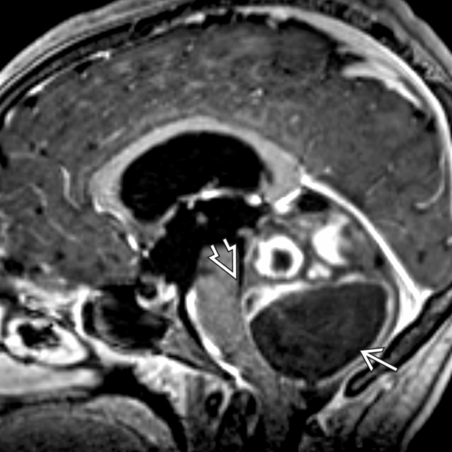 Sagittal T1 C+ FS MR shows a pilocytic astrocytoma involving the cerebellum with heterogeneous enhancement and a large cyst
. Note the effacement of the 4th ventricle
rather than expansion, which would be typical for medulloblastoma and ependymomas.