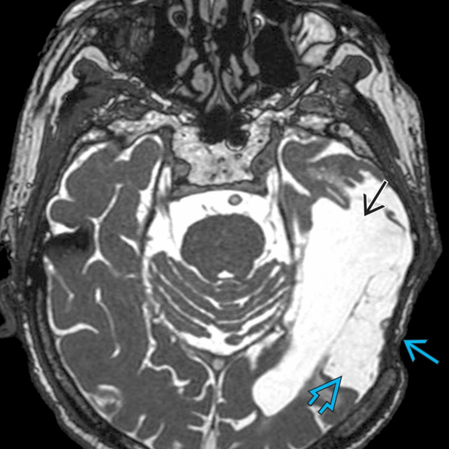 Axial FIESTA MR in a patient following left temporal bone surgery shows skull defect
, underlying encephalomalacia
, and ex vacuo dilatation of the left lateral ventricle
.