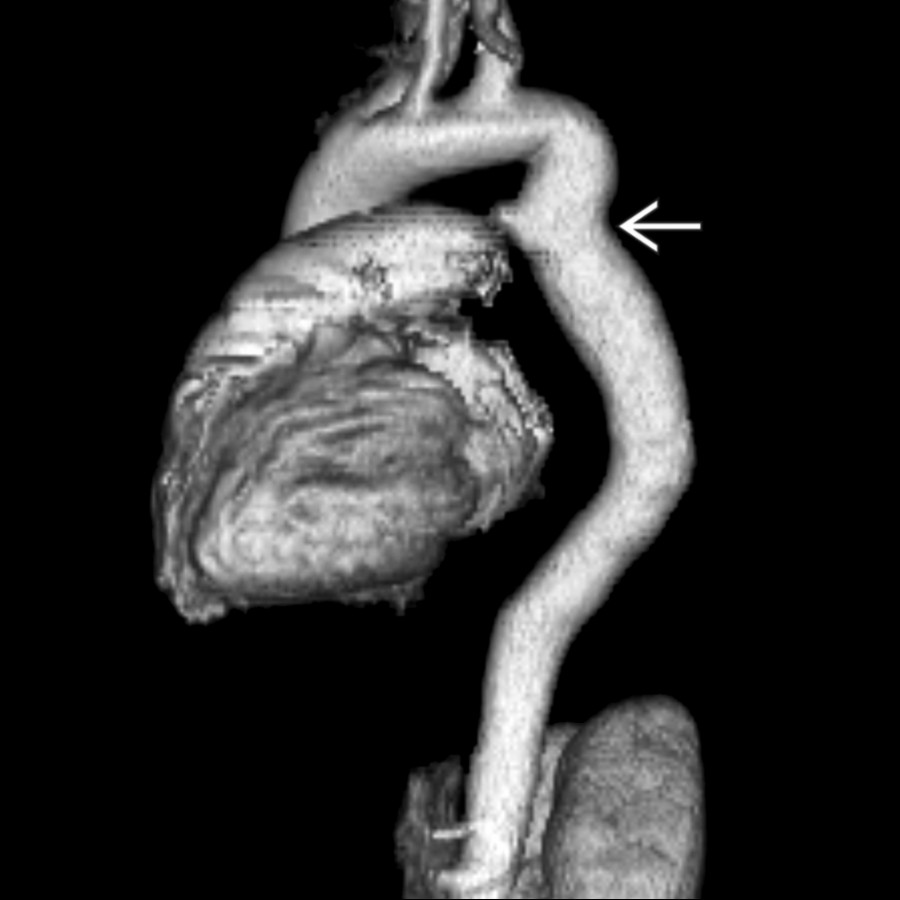 Sagittal 3D volume-rendered CTA in a patient with PCOA demonstrates kinking and mild narrowing
of the proximal descending aorta at the level of the ligamentum arteriosum.