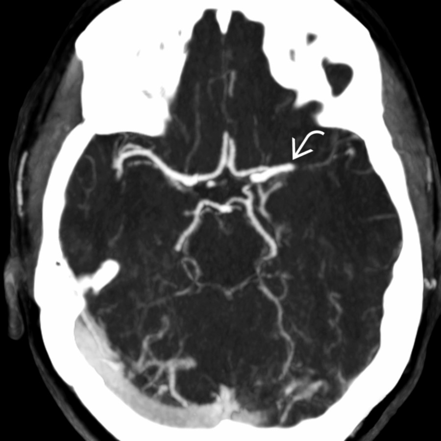 MIP of the CTA in the same patient shows an abrupt cut-off
of the proximal M1 MCA segment.