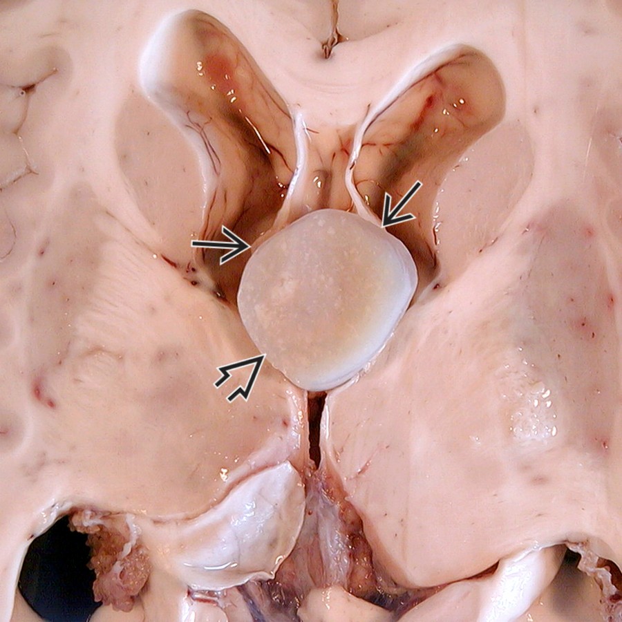 Axial gross pathology in a patient who suddenly and inexplicably died shows a large CC
causing moderate obstructive hydrocephalus. A small cavum septi pellucidi is present. Fornices
are draped over the cyst. (Courtesy R. Hewlett, MD.)