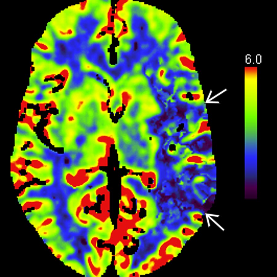 Axial CT perfusion with cerebral blood volume (CBV) shows reduced CBV
in the left temporal and parietal lobes, as well as the lateral basal ganglia, external capsule, and insula.
