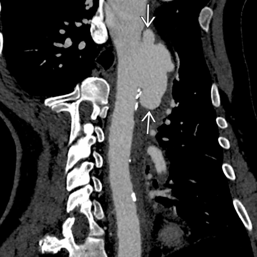 Curved planar reconstruction of the aorta in the same patient shows the size and extent of the large, lobulated saccular mycotic pseudoaneurysm
. Differentiation between a mycotic pseudoaneurysm and ruptured aneurysm can be difficult without appropriate history.