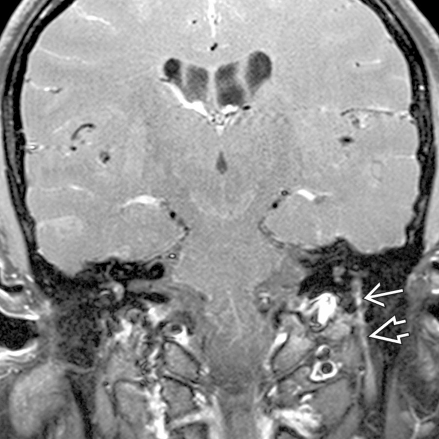 Coronal T1 C+ FS MR demonstrates avid enhancement of the mastoid segment of the facial nerve
and the proximal extracranial segment in the stylomastoid foramen
in this patient with typical acute onset Bell palsy.