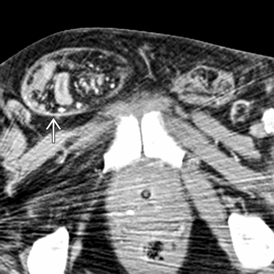 Axial CECT shows an inguinal hernia causing small bowel obstruction. Note the entrapped and thickened small bowel in the right inguinal hernia sac
.