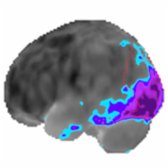 Left lateral F-18 FDG PET with quantitative mapping shows decreased activity posteriorly (blue/purple) in the same patient, predominantly in the occipital lobe (red outline). These findings are typical for LBD.