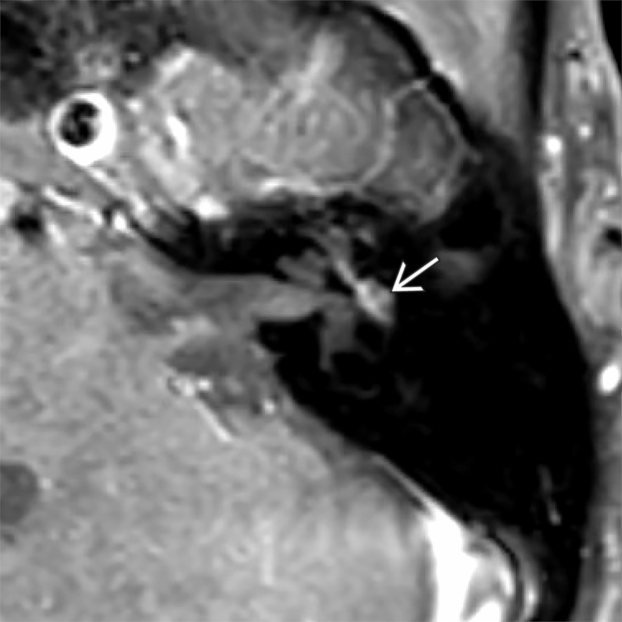 Axial T1 C+ FS MR in a patient with left facial nerve paralysis shows expansile enhancement of the tympanic segment of facial nerve
, consistent with schwannoma.