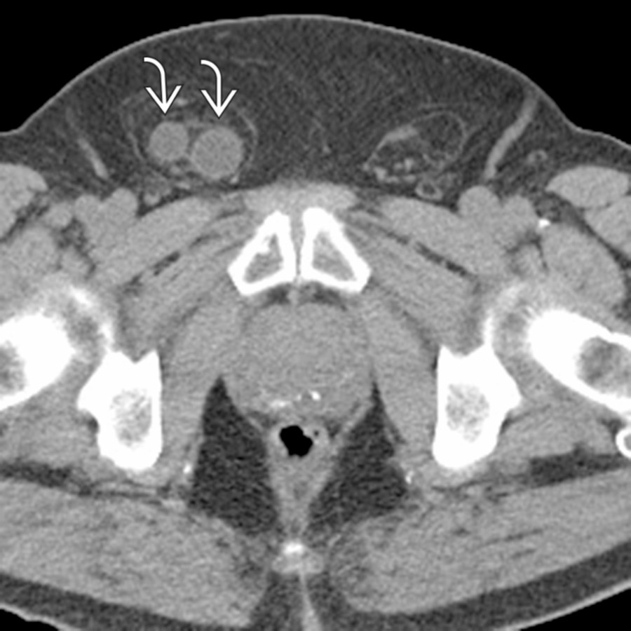 Axial NECT in the same patient demonstrates the cause of the hydronephrosis with the right ureter
trapped and dilated within a right inguinal hernia.