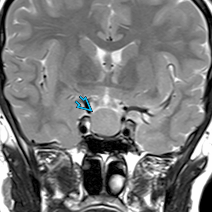 Coronal T2 MR shows a sellar/suprasellar cyst
in a 29-year-old woman with mild prolactin elevation. Rathke cleft cysts may present with symptoms related to mass effect. The prolactin elevation in this case was related to stalk effect from the cyst compressing the stalk.