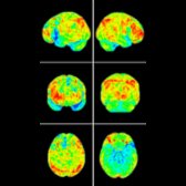 Brain surface map of F-18 FDG PET in a patient with nfvPPA demonstrates focal hypometabolism
in the inferior left frontal lobe. This may be underrepresented on the surface map due to its location immediately adjacent to the mesial temporal lobe
, so make sure to attend to this region on cross-sectional reformats.