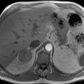 Axial in-phase T1 MR in a 77-year-old man with urothelial cancer shows a relatively homogeneous, 4.2-cm right adrenal mass
.