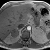 Axial in-phase T1 MR in a 77-year-old man with urothelial cancer shows a relatively homogeneous, 4.2-cm right adrenal mass
.