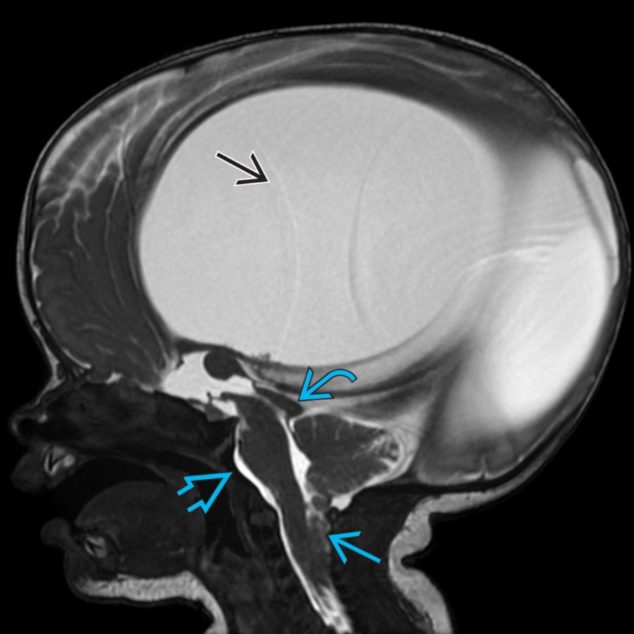 Sagittal 3D SSFP MR in a neonate with a myelomeningocele shows marked enlargement of the lateral ventricles
& characteristic features of Chiari 2 malformation: Small posterior fossa, brainstem & cerebellar descent
, tectal beaking
, & scalloped clivus
.