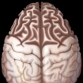 Graphic depicts the classic disproportionate frontal lobe atrophy of late-stage frontotemporal dementia (FTD). The sulci are widened & gyri are knife-like
. Parietooccipital lobes are spared. Gyri around the central sulcus are normal.