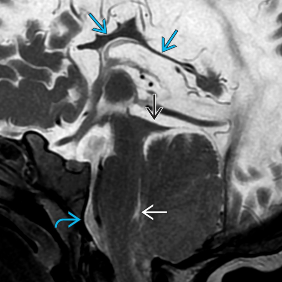 Midline sagittal T2 MR in a 15 month old with Chiari 2 malformation shows a severely thinned & dysmorphic corpus callosum
. Note the typical Chiari 2 features, including a small posterior fossa with caudal herniation of the brainstem & cerebellum, clival scalloping
, elongated 4th ventricle
, & beaked tectum
.
