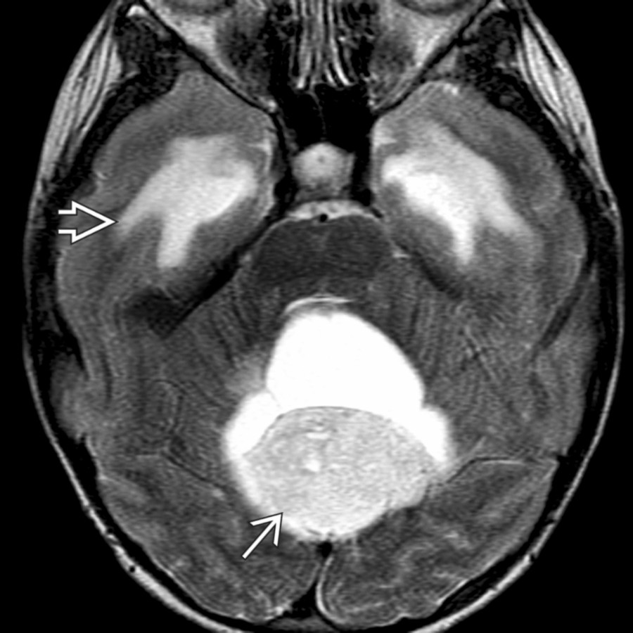 Axial T2 MR shows an increased signal of the solid component
of the mass. Interstitial edema
is present in the temporal lobes.