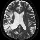 Axial T2 MR in a patient with a history of remote right MCA infarct shows the typical changes of volume loss & hyperintensity in the cortex & subcortical white matter
. The ipsilateral ventricle is enlarged.