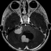 Axial T1 C+ MR shows multiple nodules in the right middle cerebellar peduncle
and vermis
in an infant. This was an SHH desmoplastic medulloblastoma. Desmoplastic histology is associated with SHH pathway alteration and can be nodular in appearance.