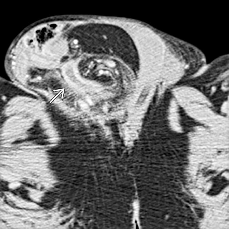 CECT shows an incarcerated small bowel with perforation within the inguinal hernia sac. Note the thickened small bowel within the large hernia sac
.