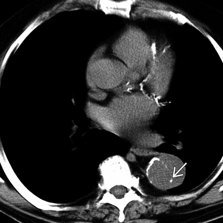 Axial NECT shows displaced intimal calcifications representing aortic dissection
.