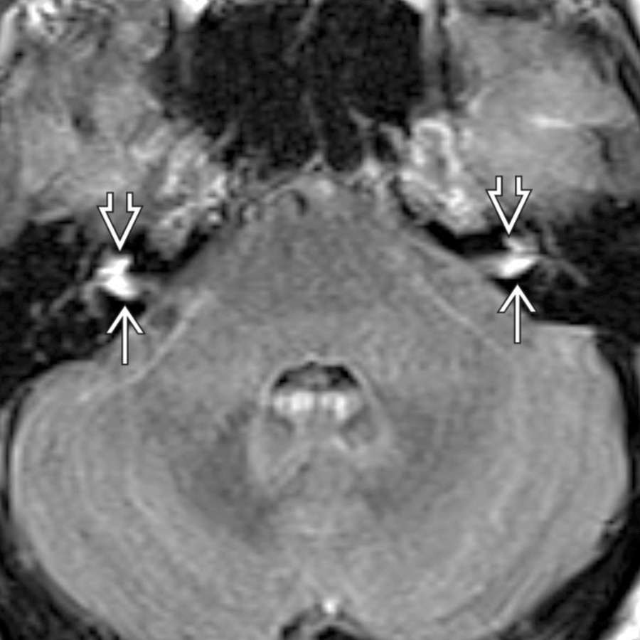 Axial FLAIR C+ MR shows leptomeningeal metastases from melanoma with enhancement at the fundus of bilateral IACs
extending into the basal turn of the cochlea
bilaterally.