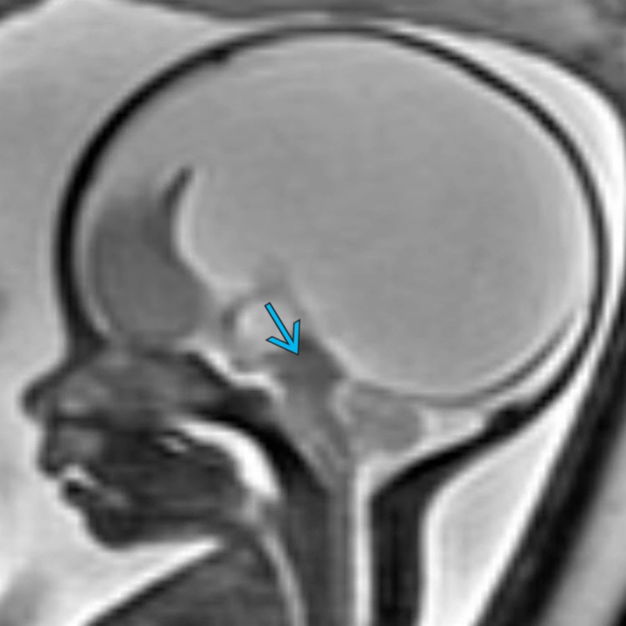 Sagittal T2WI from a fetal MR at 25 weeks gestational age with aqueductal stenosis shows macrocephaly, lateral and 3rd ventriculomegaly, and no CSF in the cerebral aqueduct
.