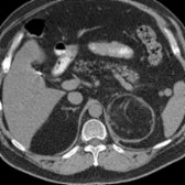 Axial CECT in a 55-year-old man with left flank pain shows a large, fat-attenuation mass
, soft tissue attenuation rim, and perinephric infiltration.
