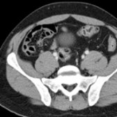 Axial correlative CECT shows the psoas muscle has begun its dorsolateral course and is now anterior to the iliacus muscle. The iliacus muscle is easily identified as a flat muscle filling the iliac fossa, arising from the upper 2/3 of the iliac fossa, inner lip of the iliac crest, anterior sacroiliac and the iliolumbar ligaments, and base of the sacrum.
