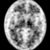 Axial amyloid β PET using florbetapir in a 63-year-old man with slowly progressive dementia shows moderate amyloid neuritic plaque burden
indicating AD.
