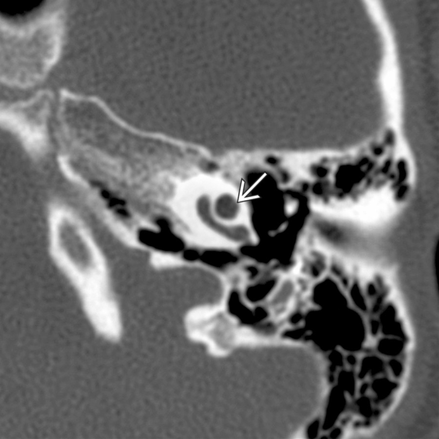 Axial bone CT in an 8-year-old child with severe bilateral sensorineural hearing loss (SNHL) shows incomplete partitioning between the middle and apical turns of the left cochlea
, typical of IP-II morphology.