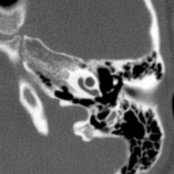 Axial bone CT in an 8-year-old child with severe bilateral sensorineural hearing loss (SNHL) shows incomplete partitioning between the middle and apical turns of the left cochlea
, typical of IP-II morphology.