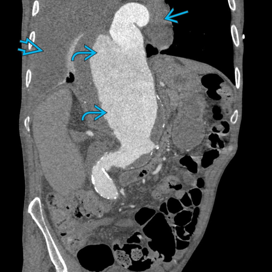 CTA in the same patient after he traveled to the USA shows rupture of a large thoracoabdominal aortic aneurysm
with right hemothorax
and blood in the mediastinum
.