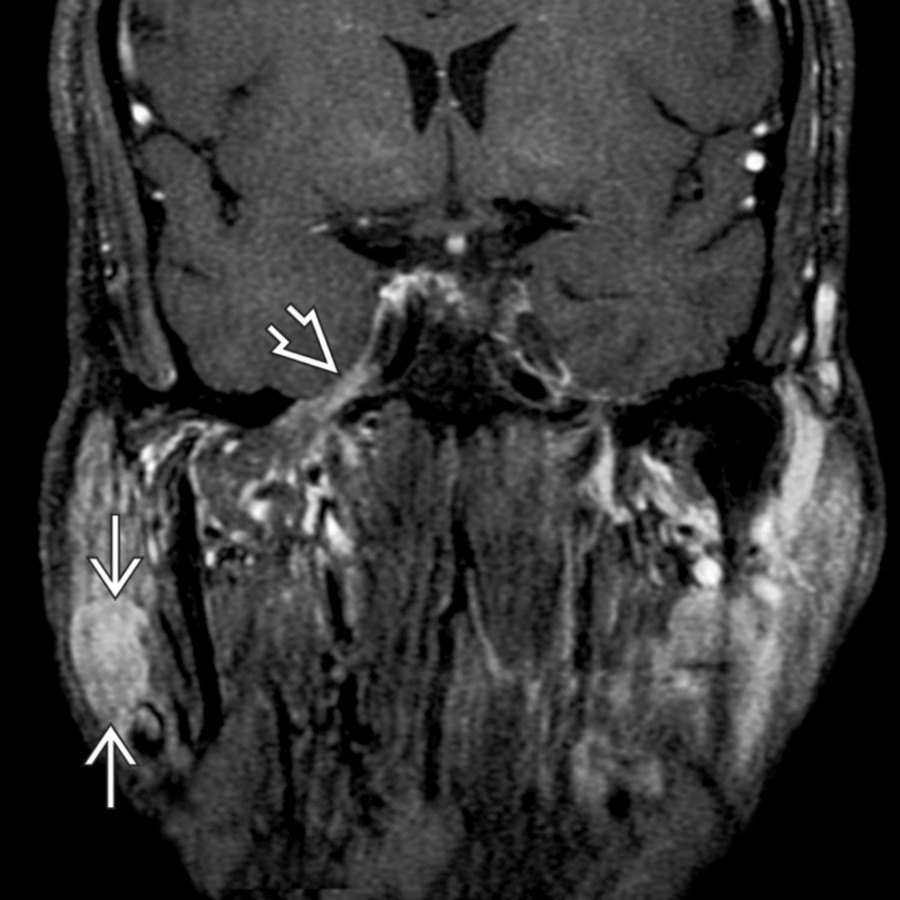 Coronal T1 C+ FS MR shows a tubular mass
in the inferior superficial parotid lobe. Small schwannomas usually do not have cystic regions. This patient has neurofibromatosis type 2, as evidenced by the schwannoma along CNV3
.