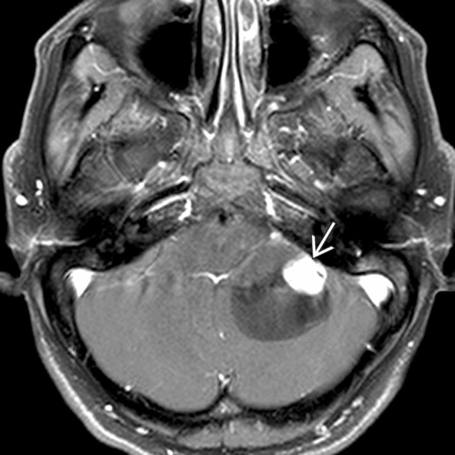 Axial T1 C+ FS MR shows a superficial, intracerebellar mixed cystic-solid hemangioblastoma projecting into the left CPA cistern area. The solid nodule
is avidly enhancing.