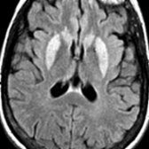 Axial FLAIR MR shows symmetric hyperintensity in the caudate and putamen, characteristic of sCJD. sCJD is the most common type of CJD, representing 85% of cases.