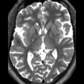 Axial thin 3D T2 SPACE MR in the same SCA3/MJD patient shows tiny hyperintensities just outside the internal capsules, at the inner segments of globi pallidi
.