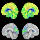Right & left medial sagittal FDG PET source & 3DSSP images of a 74-year-old man with dementia with Lewy bodies (DLB) presenting with visual hallucinations show severe ↓ metabolic activity in left visual cortex
& precuneus
. Note moderate ↓ metabolic activity in right occipital lobe
& precuneus
& relative sparing of bilateral posterior cingulate gyri
.