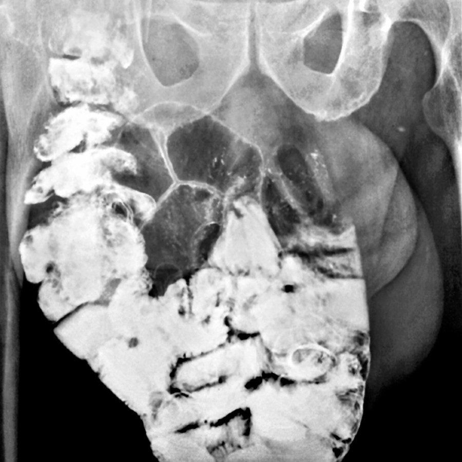 Small bowel follow-through shows a large portion of the small intestine within the scrotum due to a right inguinal hernia.