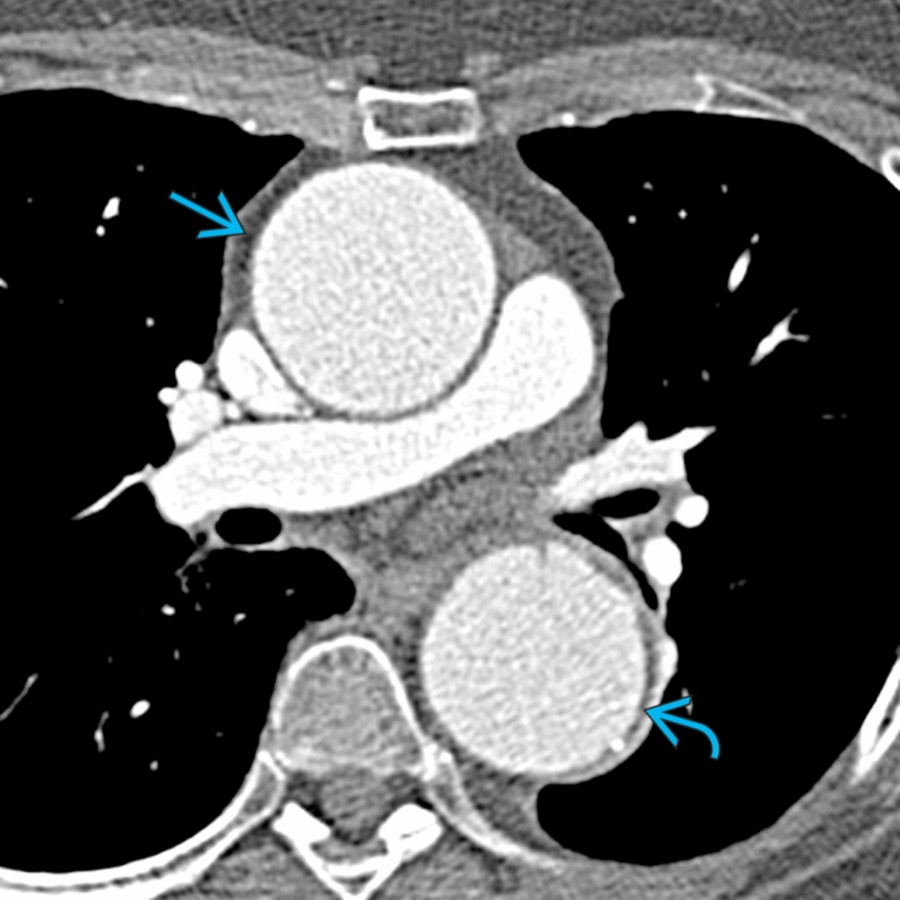 Axial CTA in a patient with unsuspected GCA who underwent reconstruction of the ascending aorta due to aneurysm is shown. Note the aneurysmal ascending
and descending aorta
.