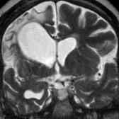 Coronal T2 TSE of 55-year-old man with past history of right middle cerebral artery (MCA) distribution infarction shows encephalomalacia in the right frontal & temporal lobes
with ex vacuo dilation of right lateral ventricle
due to volume loss.