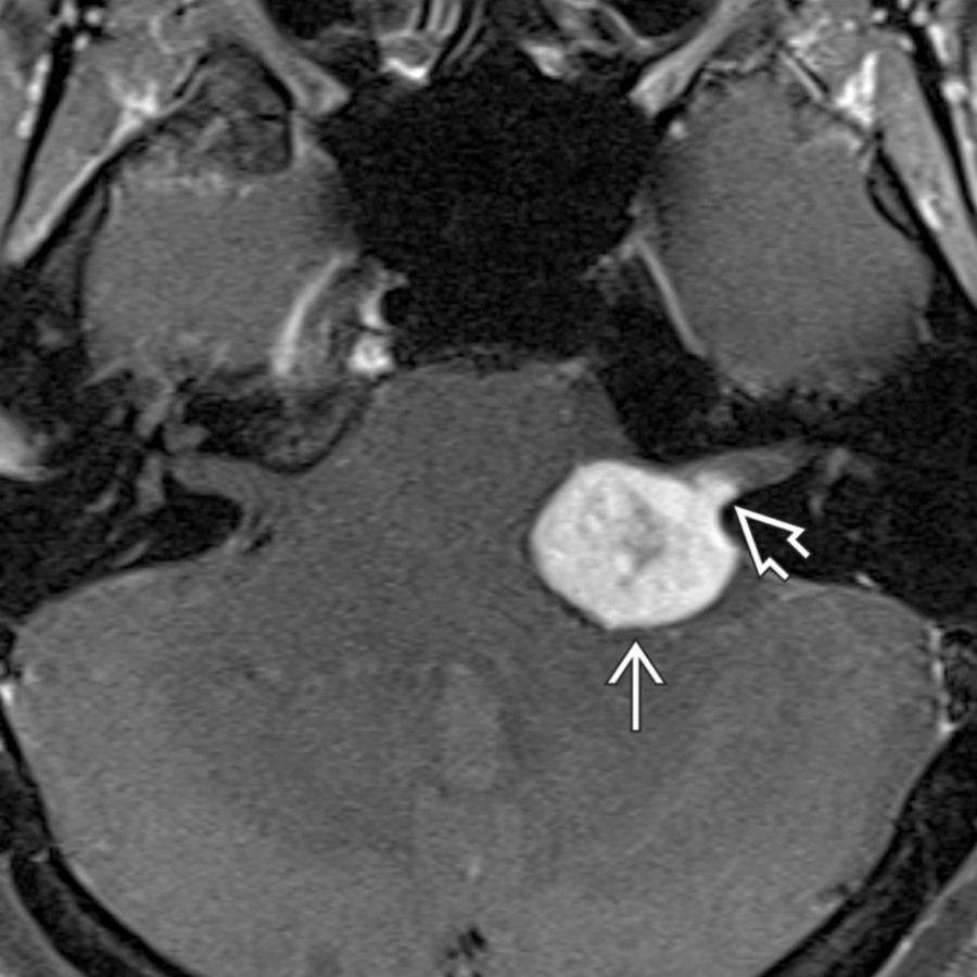 Axial T1 C+ FS MR shows the typical appearance of a CPA-IAC vestibular schwannoma
with avid, heterogeneous enhancement. Note tumor growth along the location of the vestibular nerve within the posterior IAC
.