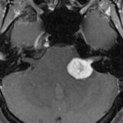 Axial T1 C+ FS MR shows the typical appearance of a CPA-IAC vestibular schwannoma
with avid, heterogeneous enhancement. Note tumor growth along the location of the vestibular nerve within the posterior IAC
.
