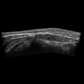 Longitudinal extended FOV grayscale image shows the relationship between the rectus abdominis and the oblique muscles.