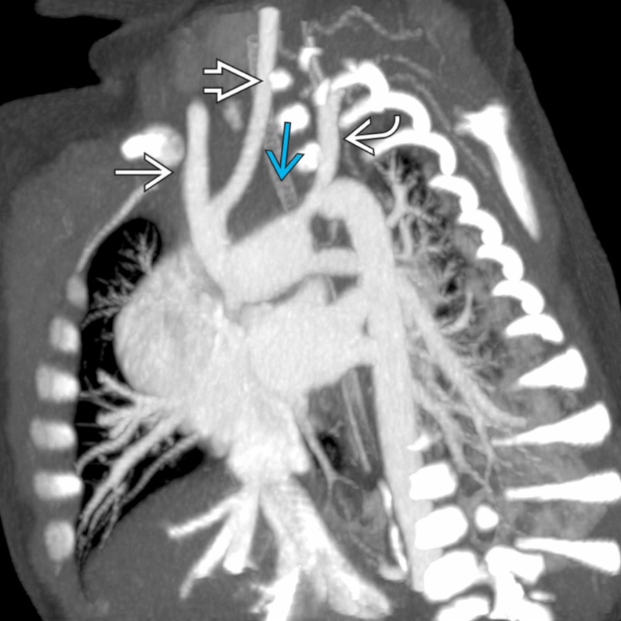 Sagittal oblique MIP CTA shows type B IAA
. The BCT
and left common carotid artery (LCC)
originate from the proximal aorta. The LSA
originates from the ductal arch.
