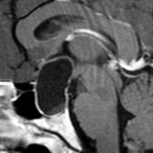 Sagittal T1 C+ MR shows the 3rd ventricle is elevated and draped over the mass.