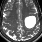Axial T2 MR shows a large, well-defined cyst
in the left posterior frontal region. The cyst showed CSF signal on all sequences, which is typical for a neuroglial cyst.