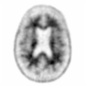 Axial F-18 florbetapir PET demonstrates characteristic physiologic uptake in the white matter
but no significant uptake in the gray matter
. This clear distinction indicates no detectable amyloid deposition.