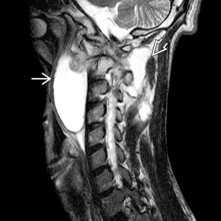 Sagittal T2WI MR shows a large prevertebral abscess spanning C1 to C4
and extension posteriorly involving the interspinous region
. These findings are typical for tuberculosis (TB).