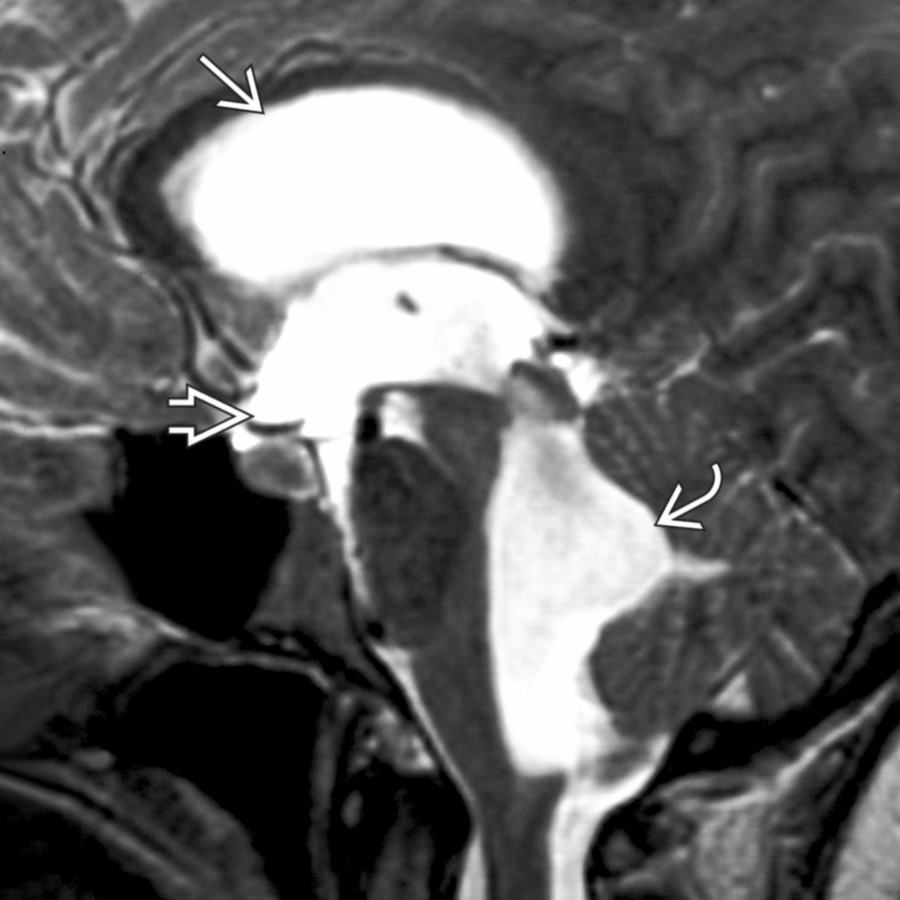 Sagittal T2WI MR shows extraventricular obstructive hydrocephalus (EVOH) with markedly enlarged lateral
, 3rd
, and 4th
ventricles. A CSF suprasellar mass caused by an enlarged 3rd ventricle was diagnosed.